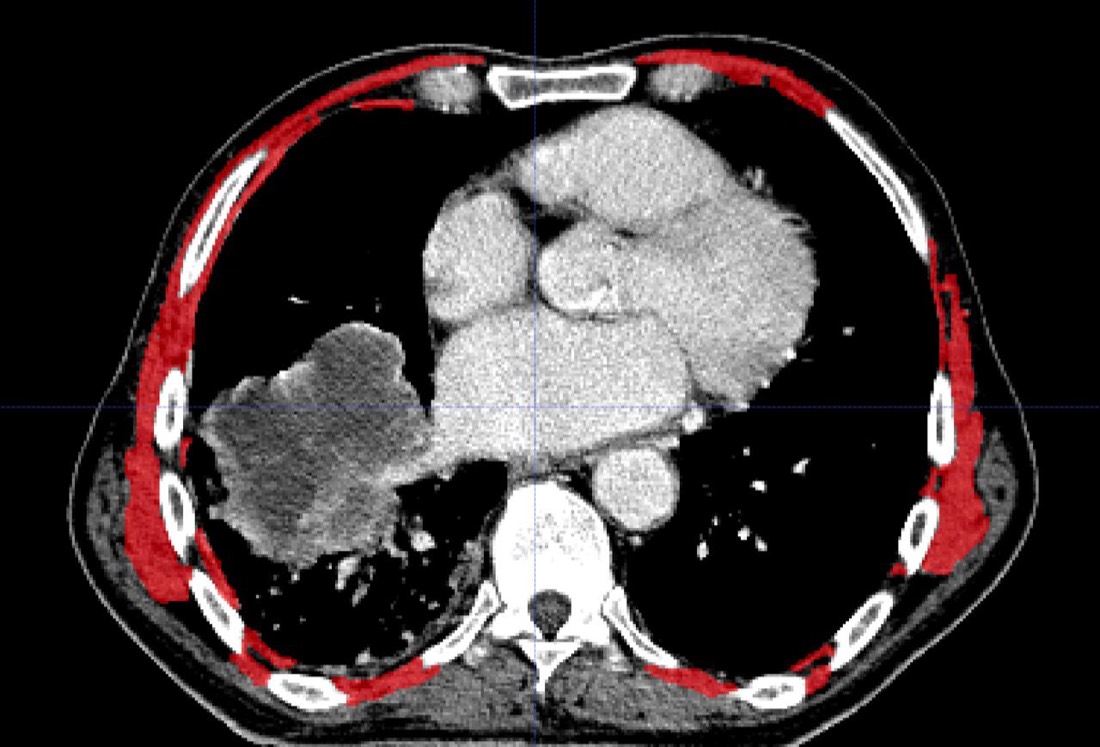 CT slice with periskeletal segmentation mask